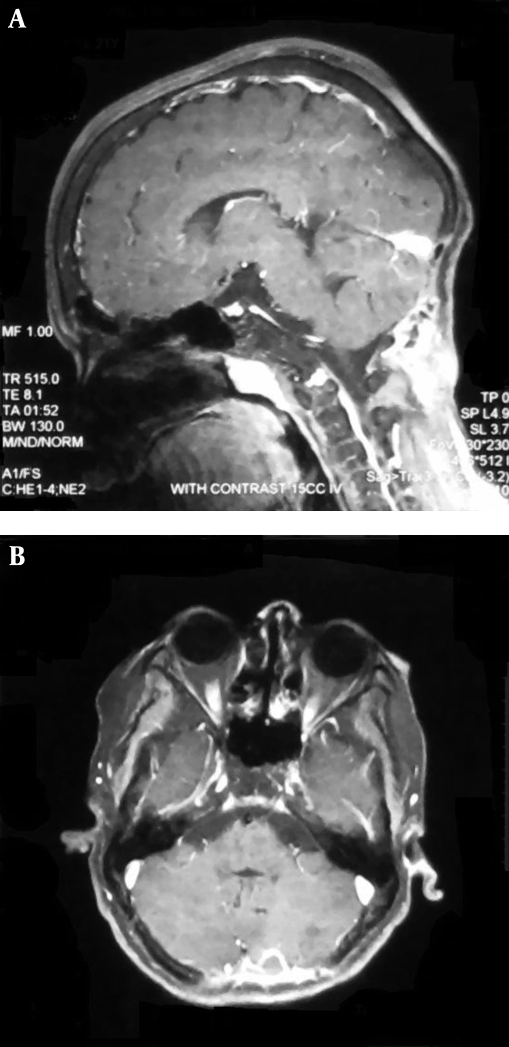 Sagittal (A) and Axial (B) Preoperative MRI of the Patient Showing Resolved Lesion Sagittal (A) and Axial (B) Preoperative MRI of the Patient Showing Resolved Lesion