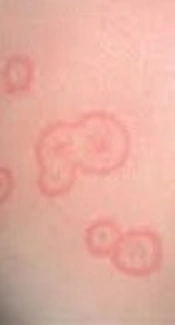 Specific Identification and Antifungal Susceptibility Pattern of Clinically Important Dermatophyte Species Isolated from Patients with Dermatophytosis in Tehran, Iran