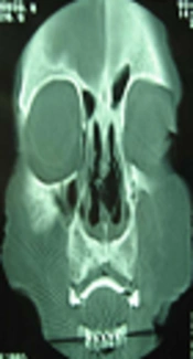 Leprosy and Rhinoscleroma: A Rare Case of Concurrence