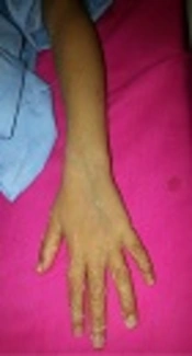 Skin and Soft Tissue Infection as a Complication of Varicella Infection Ended up in Using Intravenous Immunoglobulin Instead of Surgical Debridement: A Case Report and Short Review of Literature