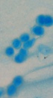 Antifungal Resistant Gastrointestinal Basidiobolomycosis Without Eosinophilia: A Case Report