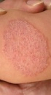 Consideration of Invasive Fungal Infections in Immunocompetent Hosts