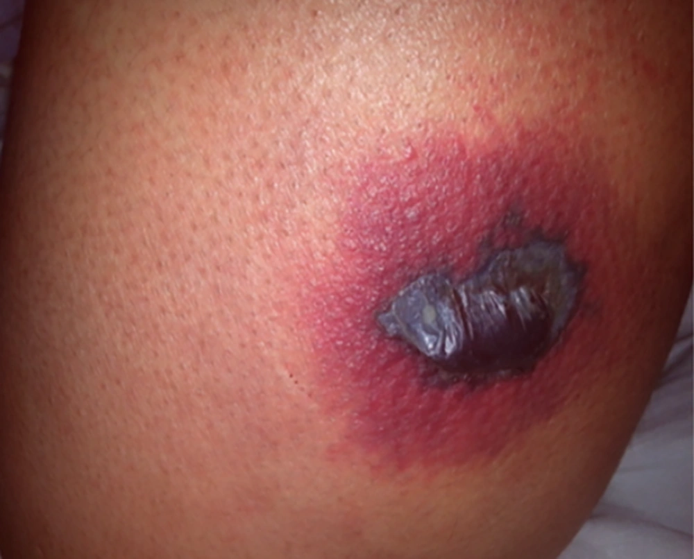 Erythematous round lesion with central bolus necrosis Erythematous round lesion with central bolus necrosis