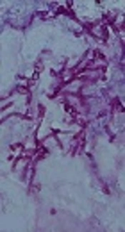 Severe Disseminated Phaeohyphomycosis in a Patient with Inherited CARD9 Deficiency