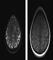 Progressive Multifocal Leukoencephalopathy as the First Manifestation of AIDS: A Rare Case Report