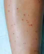 Simultaneous Occurrence of Papulonecrotic Tuberculid and Erythema Induratum in a Patient Without a Previous History of Tuberculosis Infection: A Case Report and Review of Literature