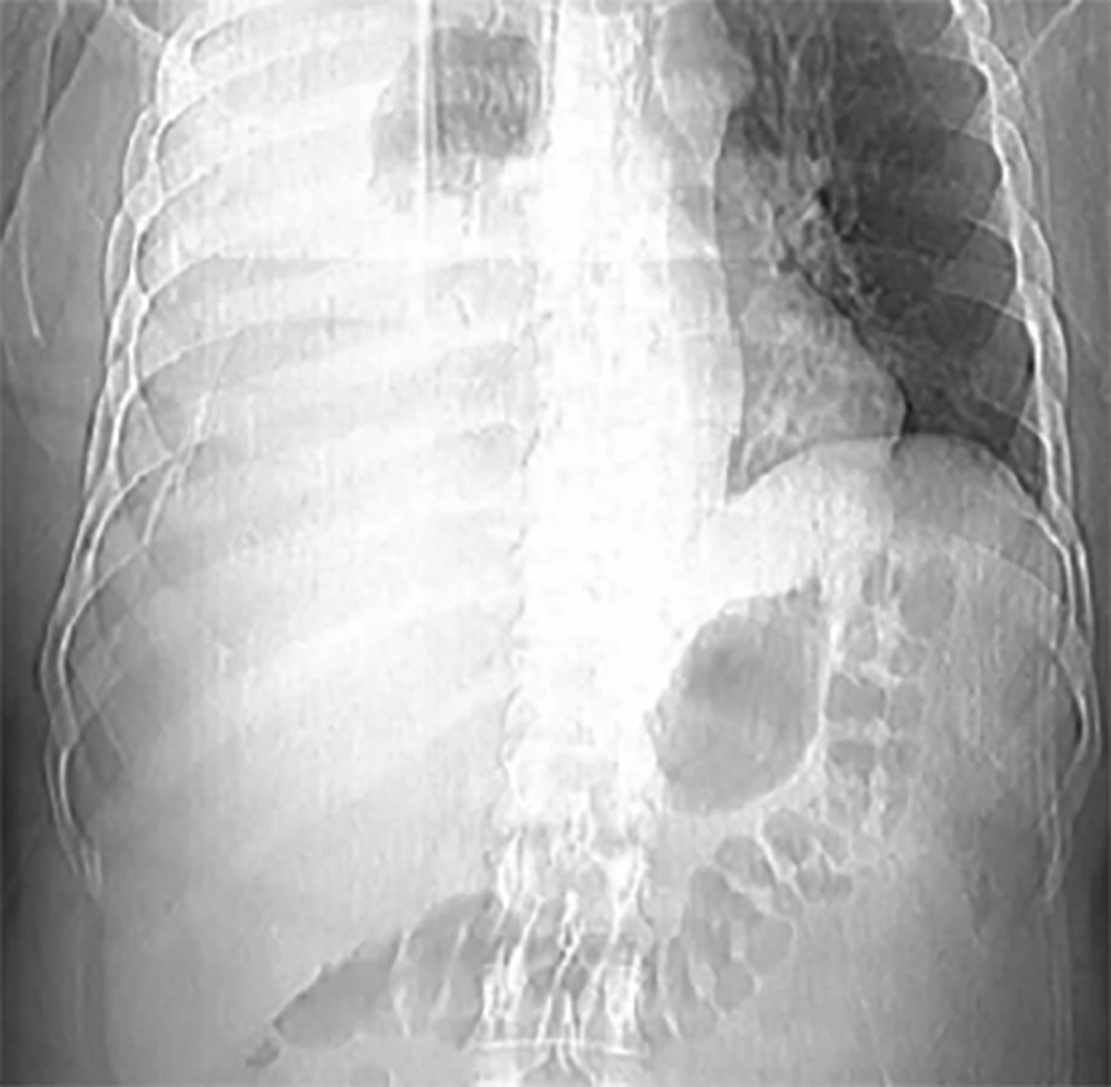 Massive pleural effusion in the right side Massive pleural effusion in the right side