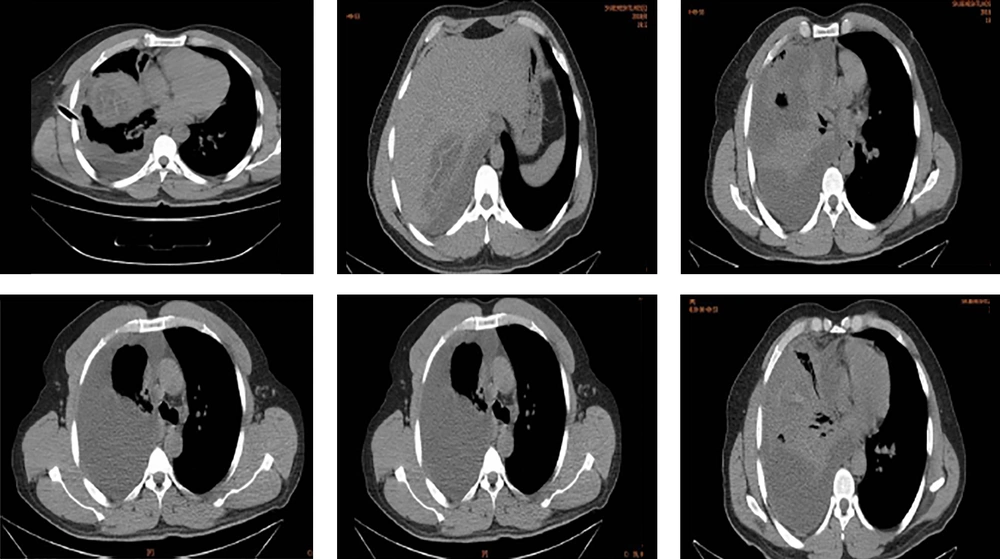 CT scan revealed hypoechoic lesion in the right lobe of the liver CT scan revealed hypoechoic lesion in the right lobe of the liver