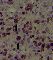 The Study of Menin Expression as a Diagnostic Factor in HBV-Related Hepatocellular Carcinoma