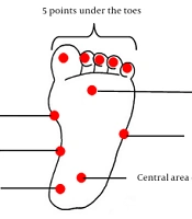 The Effect of Fatigue on the Pain Threshold in the Soles of the Feet of Mountaineers Before and After a Mountaineering Session