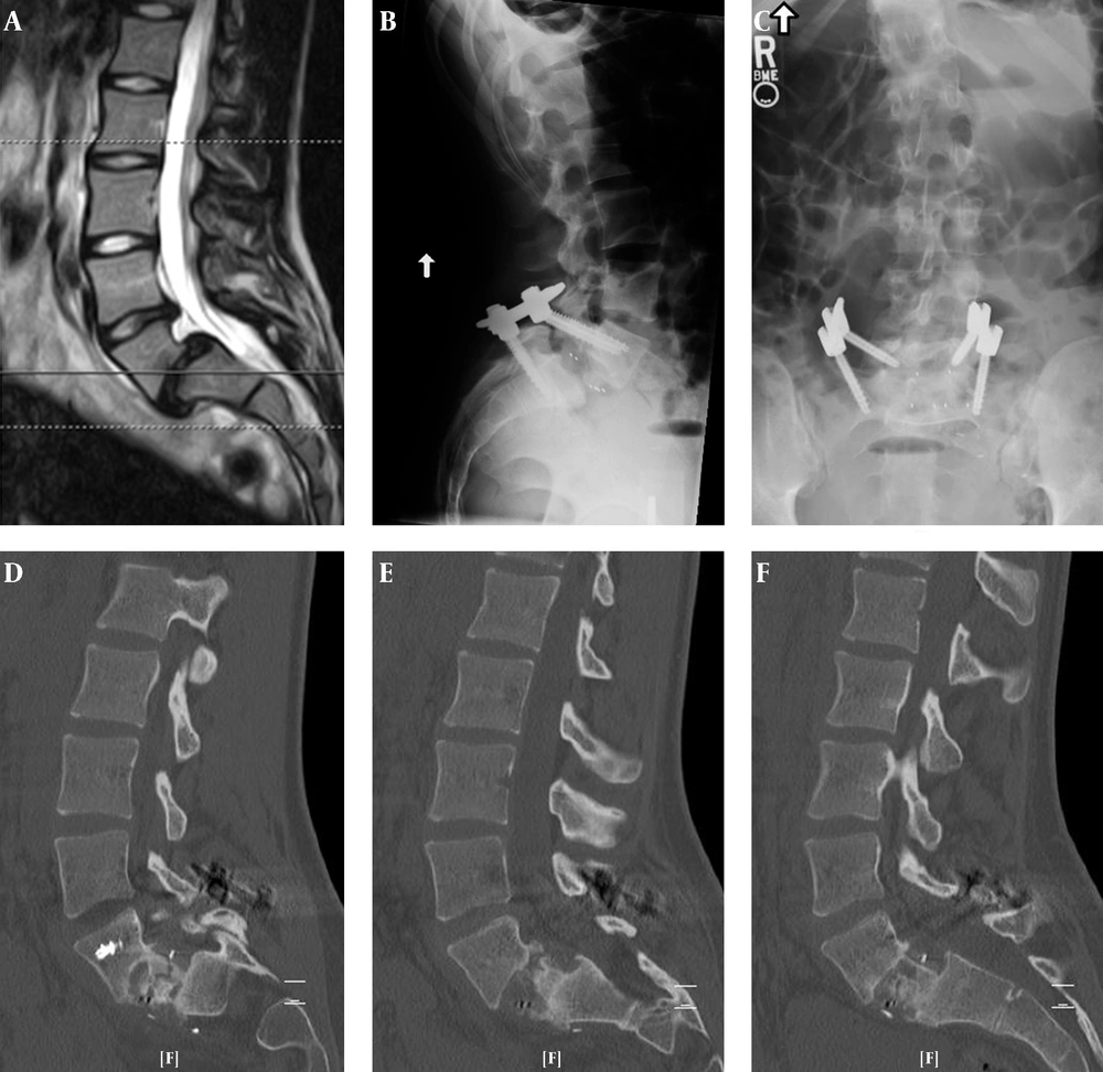 A 22-years-old Female Olympic Equestrian, Presented with Grade III Spondylolisthesis without Neurological Deficits. After a one-Level Anterior Lumbar Interbody Fusion with Percutaneous Posterior Fixation, Solid Fusion was Achieved 4 Months after the Operation. The Patient was Able to Successfully Return to Competitive Horseback Ridin A 22-years-old Female Olympic Equestrian, Presented with Grade III Spondylolisthesis without Neurological Deficits. After a one-Level Anterior Lumbar Interbody Fusion with Percutaneous Posterior Fixation, Solid Fusion was Achieved 4 Months after the Operation. The Patient was Able to Successfully Return to Competitive Horseback Ridin