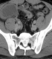 Mucocele of the Appendix Discovered Golestan Hospital of Ahwaz: A Case Report