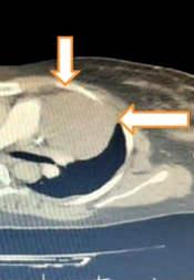 Cover image of the article: Maternal Mortality Due to an Undiagnosed Large Thymoma in Puerperium: A Case Report