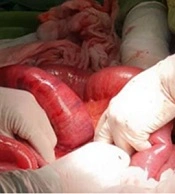 The Role of Increasing Serum C-reactive Protein Level in Diagnosis of Post-surgery Small Bowel Pseudo-obstruction: A Case Report