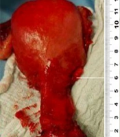 Undiagnosed Supra-vaginal Cervical Elongation in a Case of Recurrent Pelvic Organ Prolapse After Sacrospinous Hysteropexy: A Case Report