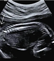 Cover image of the article: Human Tails and Whole Exome Sequencing Findings: Is There any Association? A Case Report