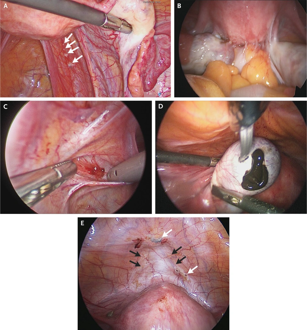 Stages of endometriosis (<a href="#A151749REF18">18</a>); A, minimal endometriosis with four peritoneal endometriotic lesions (white arrows) on the right pelvic side wall; B, extensive endometriosis with bowel adhesions to the uterus; C, superficial red peritoneal endometriotic lesion and hyperemia; D, endometrioma (chocolate cyst) in the left ovary; E, deep bladder nodule (black arrows) and red, brown, and black peritoneal endometriotic lesions (white arrows). Stages of endometriosis (<a href="#A151749REF18">18</a>); A, minimal endometriosis with four peritoneal endometriotic lesions (white arrows) on the right pelvic side wall; B, extensive endometriosis with bowel adhesions to the uterus; C, superficial red peritoneal endometriotic lesion and hyperemia; D, endometrioma (chocolate cyst) in the left ovary; E, deep bladder nodule (black arrows) and red, brown, and black peritoneal endometriotic lesions (white arrows).