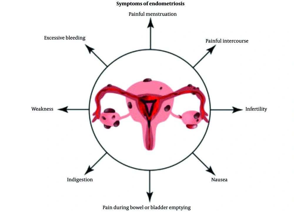 Symptoms of endometriosis (<a href="#A151749REF3">3</a>); this figure shows the symptoms associated with endometriosis. Symptoms of endometriosis (<a href="#A151749REF3">3</a>); this figure shows the symptoms associated with endometriosis.