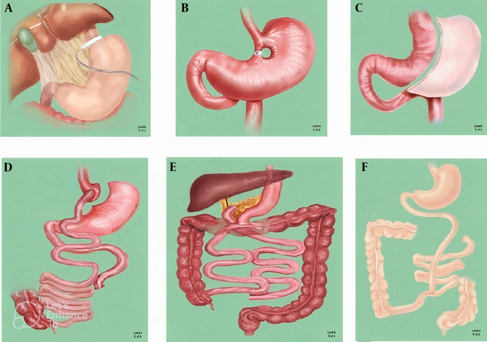 Bariatric surgical procedures: A; laparoscopic adjustable gastric banding; B, vertical banded gastroplasty; C, laparoscopic sleeve gastrectomy; D, Roux-en-Y gastric bypass; E, biliopancreatic diversion; F, jejunoileal bypass (<a href="#A156503REF41">41</a>). Bariatric surgical procedures: A; laparoscopic adjustable gastric banding; B, vertical banded gastroplasty; C, laparoscopic sleeve gastrectomy; D, Roux-en-Y gastric bypass; E, biliopancreatic diversion; F, jejunoileal bypass (<a href="#A156503REF41">41</a>).