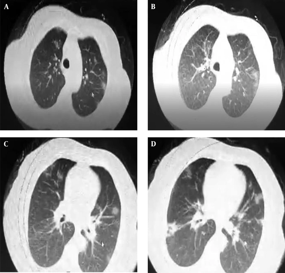 Chest imaging of the patient. (A-D) Chest CT taken on March 17, 2020 (four days after the symptom onset, the same day, the patient was admitted to the hospital) shows bilateral ground-glass opacities. Chest imaging of the patient. (A-D) Chest CT taken on March 17, 2020 (four days after the symptom onset, the same day, the patient was admitted to the hospital) shows bilateral ground-glass opacities.