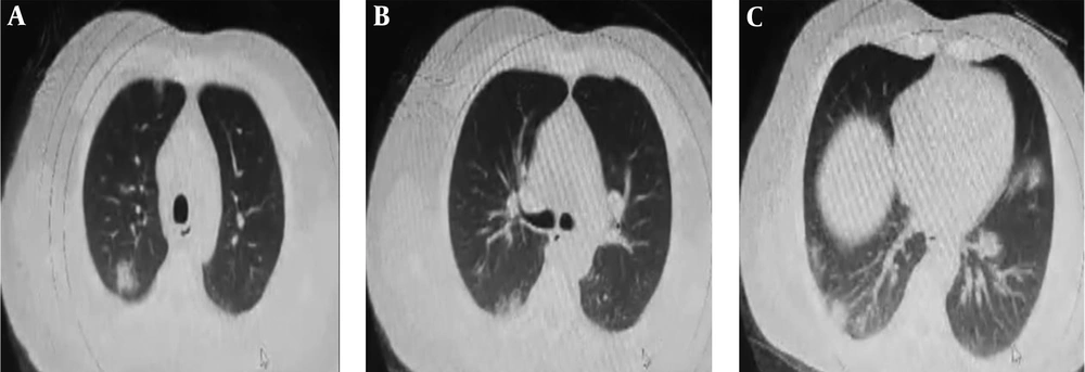 Chest imaging of the patient. (a-c) Chest CT shows peripheral ground-glass opacities. Chest imaging of the patient. (a-c) Chest CT shows peripheral ground-glass opacities.