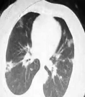 A Case Study of Hypertension and COVID-19