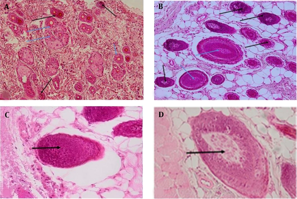 Hematoxylin-eosin staining in experimental groups 21 days after the last administration; Black and white arrows showing the telogenic and anagenic hair follicles, respectively; A, Grape sap-treated group (10 mg/kg); B, Grape sap-treated group (100 mg/kg); C, untreated group receiving bleomycin 21 days after the last administration (×20 magnification), arrow showing the telogenic hair follicle; D, Normal saline group 21 days after the last administration (×20 magnification), arrow showing the anagenic hair follicle (×10 magnification). Hematoxylin-eosin staining in experimental groups 21 days after the last administration; Black and white arrows showing the telogenic and anagenic hair follicles, respectively; A, Grape sap-treated group (10 mg/kg); B, Grape sap-treated group (100 mg/kg); C, untreated group receiving bleomycin 21 days after the last administration (×20 magnification), arrow showing the telogenic hair follicle; D, Normal saline group 21 days after the last administration (×20 magnification), arrow showing the anagenic hair follicle (×10 magnification).