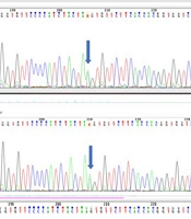 Investigating the Genetic Cause of Ichthyosis Disease in a Family with Exome Sequencing