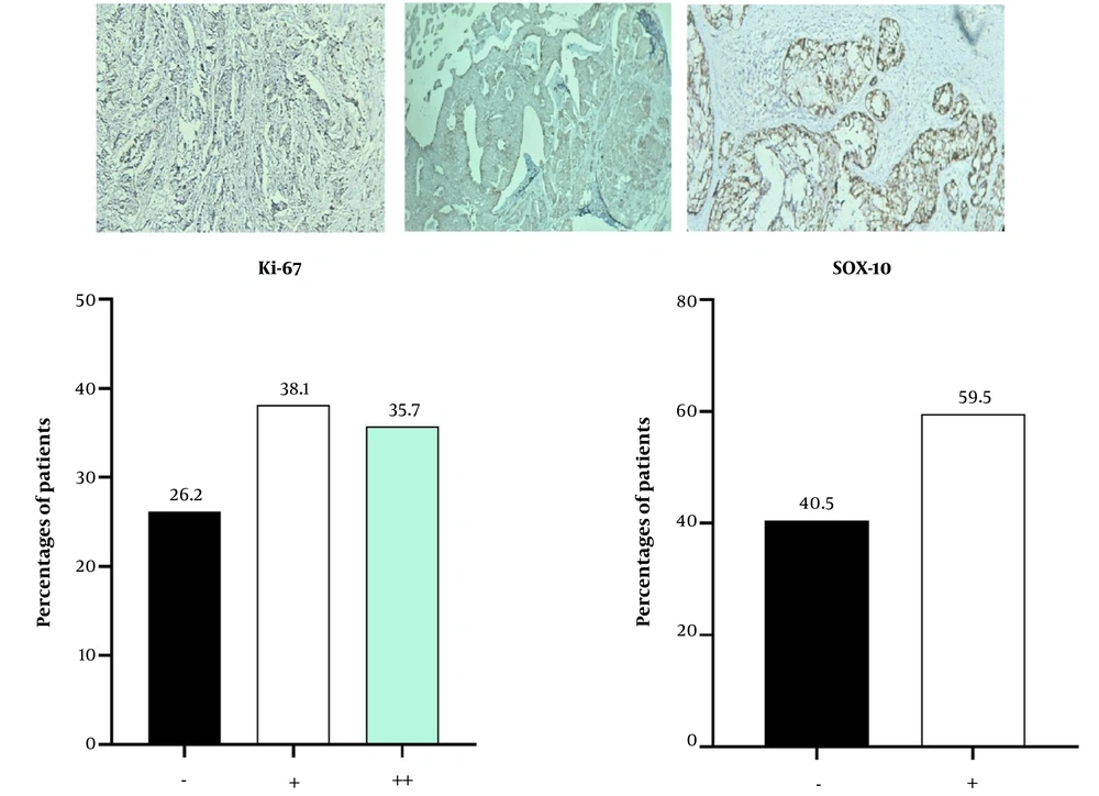 The percentage of breast cancer tumors with Ki-67 and SOX-10 expressions (n = 42) and histological images of them (above): 38.1% and 35.7% of patients were Ki-67 + and ++ respectively, and 59.5% of patients were SOX-10 positive. The percentage of breast cancer tumors with Ki-67 and SOX-10 expressions (n = 42) and histological images of them (above): 38.1% and 35.7% of patients were Ki-67 + and ++ respectively, and 59.5% of patients were SOX-10 positive.