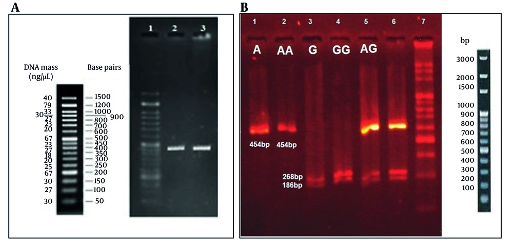 A, result of PCR product on agarose gel; B, result of restriction enzyme DraII products on 3% agarose gel: Findings based on DraII restricted enzyme on 3% agarose gel electrophoresis. The first line shows a 45 bp band, so it is expected for a man with the A genotype. Based on the second line that demonstrates a 454 bp band, it can be concluded as AA genotype for that female. The third line shows 268 and 186 bp bands, which is expected for a male patient with the G genotype, and regarding the fourth line that shows 268 and 186 bp bands, it can be concluded as GG genotype for a female patient. The fifth and sixth lines have 454, 268, and 186 bp bands, which show GA genotype for a female patient. The last line belongs to the 100 bp ladder. Because glutamate ionotropic receptor AMPA type subunit 3 (GRIA3) is located on the X chromosome, a sex-stratified descriptive analysis was performed; however, due to the small number of male participants (n = 22), statistical power was insufficient for meaningful subgroup comparison. A, result of PCR product on agarose gel; B, result of restriction enzyme DraII products on 3% agarose gel: Findings based on DraII restricted enzyme on 3% agarose gel electrophoresis. The first line shows a 45 bp band, so it is expected for a man with the A genotype. Based on the second line that demonstrates a 454 bp band, it can be concluded as AA genotype for that female. The third line shows 268 and 186 bp bands, which is expected for a male patient with the G genotype, and regarding the fourth line that shows 268 and 186 bp bands, it can be concluded as GG genotype for a female patient. The fifth and sixth lines have 454, 268, and 186 bp bands, which show GA genotype for a female patient. The last line belongs to the 100 bp ladder. Because glutamate ionotropic receptor AMPA type subunit 3 (GRIA3) is located on the X chromosome, a sex-stratified descriptive analysis was performed; however, due to the small number of male participants (n = 22), statistical power was insufficient for meaningful subgroup comparison.