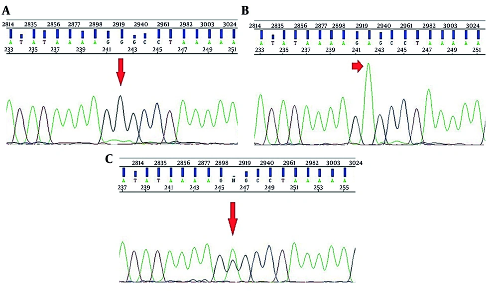 Sequencing results for RFLP analysis: A, sequence result for the patient with allele G; B, sequence result for the patient with heterozygous allele A/G; C, sequence result for the patient with allele A. Sequencing results for RFLP analysis: A, sequence result for the patient with allele G; B, sequence result for the patient with heterozygous allele A/G; C, sequence result for the patient with allele A.