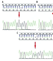 Association of GRIA3 (rs12557782) Polymorphism with Interferon Beta Resistance Among Multiple Sclerosis Patients from Qazvin Province, Iran