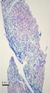 Cover image of the article: Histopathological Findings in Cholesteryl Ester Storage Disease: A Report of Three Cases