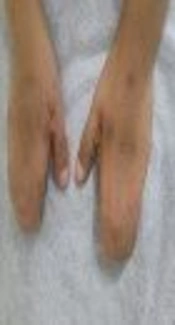 Unilateral Kidney Agenesis in a Child with Fraser Syndrome: A Case Report