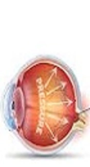 Gene-Finding Strategy in Glaucoma
