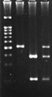 Association Study of rs763780T>C IL-17F and rs2275913G>A IL-17A Polymorphisms with Breast Cancer Risk in East Azerbaijan-Iran
