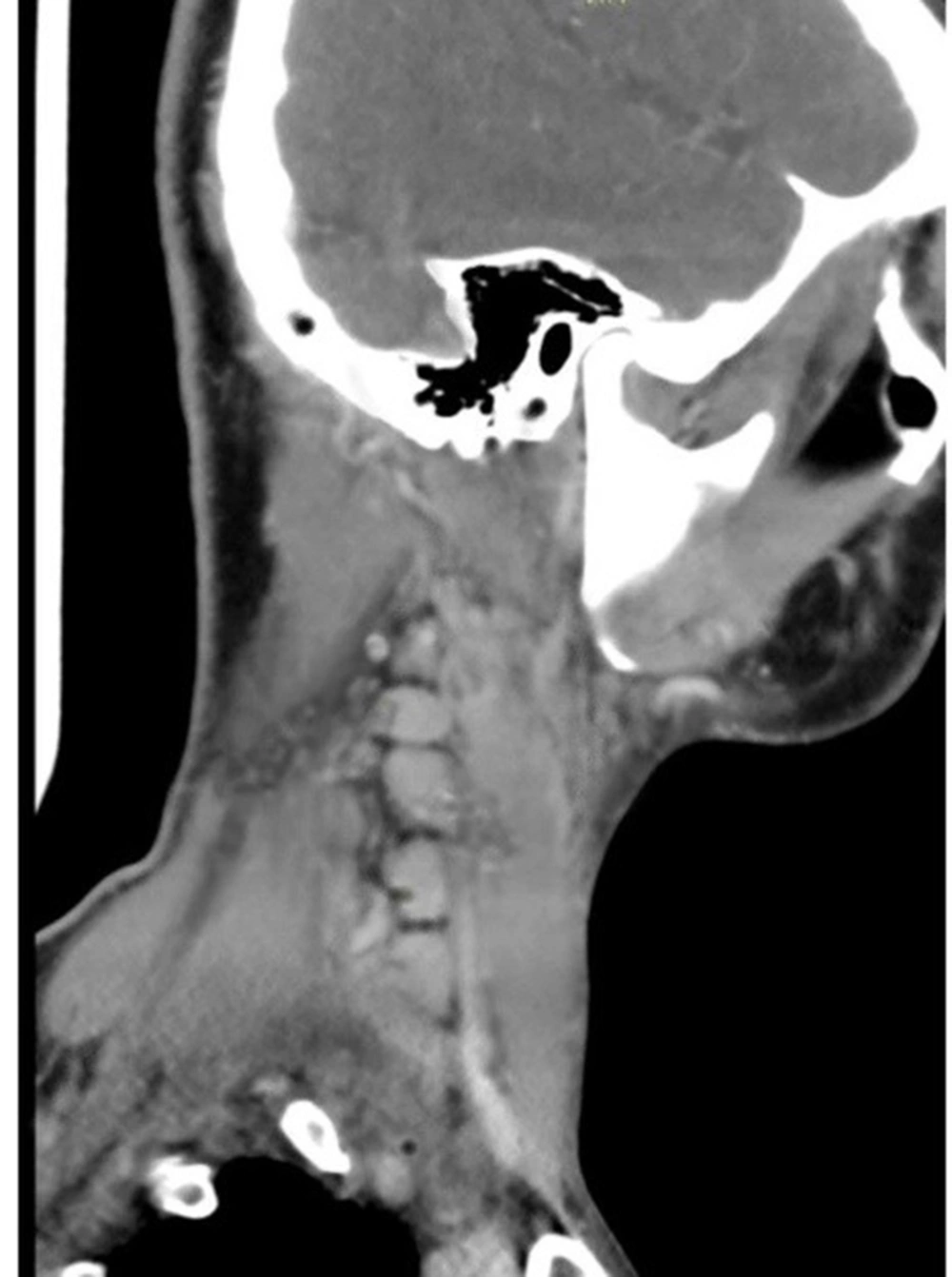 CT scan of the neck shows multiple right profound cervical lymphadenopathy in the right posterior triangle, the largest of which is 1.6 cm with central necrosis CT scan of the neck shows multiple right profound cervical lymphadenopathy in the right posterior triangle, the largest of which is 1.6 cm with central necrosis