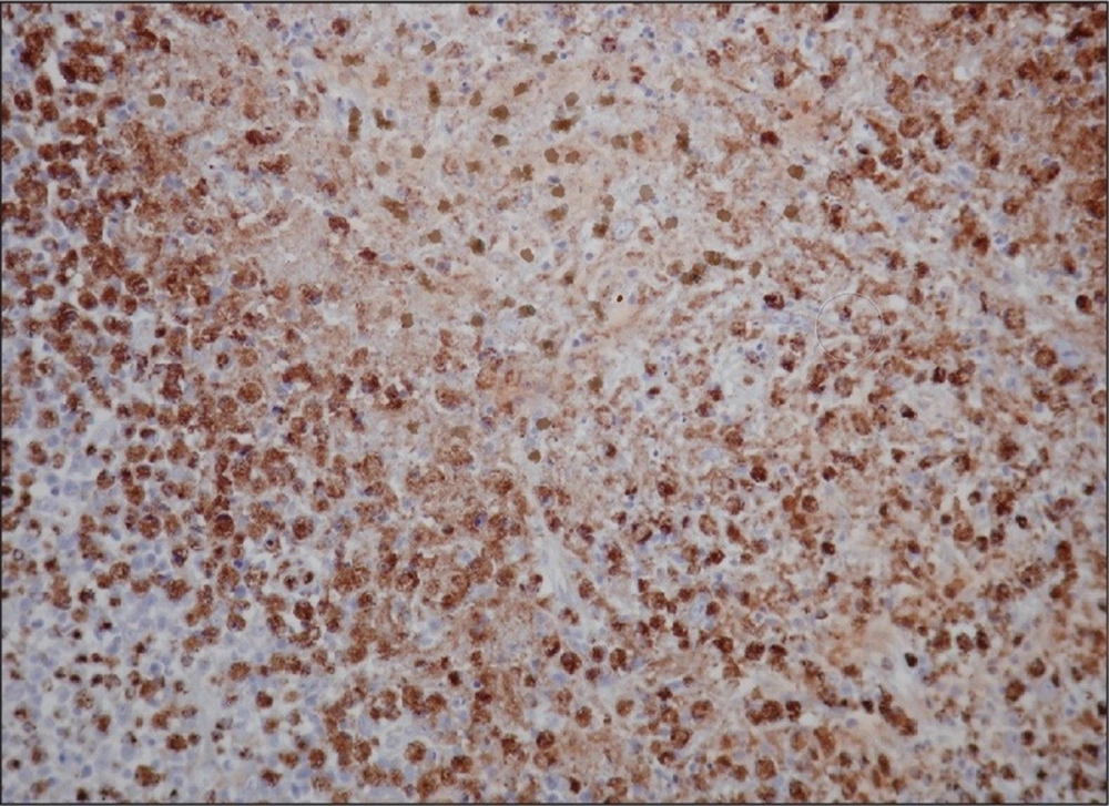 A close-up view of lymph node biopsy specimens from the individual, contrasting numerous macrophages colored brown A close-up view of lymph node biopsy specimens from the individual, contrasting numerous macrophages colored brown