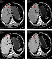 Markedly Elevated HE4 in Hepatic Neuroendocrine Neoplasm: A Report of Two Cases and Literature Review