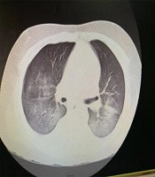 An 11-Year-Old Boy Infected with COVID-19 with Presentation of Acute Liver Failure