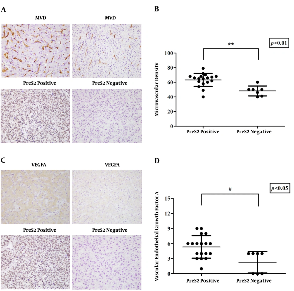 The difference in MVD counting and VEGFA expression between preS2 domain-positive HCC samples and preS2 domain-negative HCC samples. A, Immunohistochemical staining of CD34 for MVD (left upper, 400×) and preS2 (left middle, 400×) in cancer biopsies from two of 25 HCC samples; B, twenty-five HCC specimens were divided into two groups by IHC of the preS2 domain. A significant difference in MVD counting was determined by the Mann-Whitney U test (**, P < 0.01); C, immunohistochemical staining of VEGFA (right upper, 400) and preS2 (right middle, 400) in cancer biopsies from two of 25 HCC samples; D, twenty-five HCC specimens were divided into two groups by IHC of the preS2 domain. A significant difference in VEGFA levels was determined by the Mann-Whitney U test (#, P < 0.05). The difference in MVD counting and VEGFA expression between preS2 domain-positive HCC samples and preS2 domain-negative HCC samples. A, Immunohistochemical staining of CD34 for MVD (left upper, 400×) and preS2 (left middle, 400×) in cancer biopsies from two of 25 HCC samples; B, twenty-five HCC specimens were divided into two groups by IHC of the preS2 domain. A significant difference in MVD counting was determined by the Mann-Whitney U test (**, P < 0.01); C, immunohistochemical staining of VEGFA (right upper, 400) and preS2 (right middle, 400) in cancer biopsies from two of 25 HCC samples; D, twenty-five HCC specimens were divided into two groups by IHC of the preS2 domain. A significant difference in VEGFA levels was determined by the Mann-Whitney U test (#, P < 0.05).