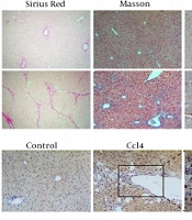 PFKFB3 Promotes Liver Fibrosis by Regulating Aerobic Glycolysis of Hepatic Stellate Cells