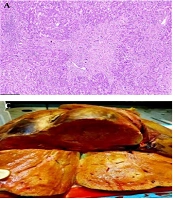 Hepatic Epithelioid Hemangioendothelioma: A Review of Three Liver Transplant Recipients
