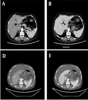 Chinese Herbal Medicine-Induced Rapid Liver Cirrhosis: A Case Report