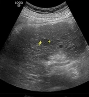 Hepatocellular Carcinoma Diagnosis Based on Ultrasound Images Using Feature Selection Techniques and K-nearest Neighbor Classifier