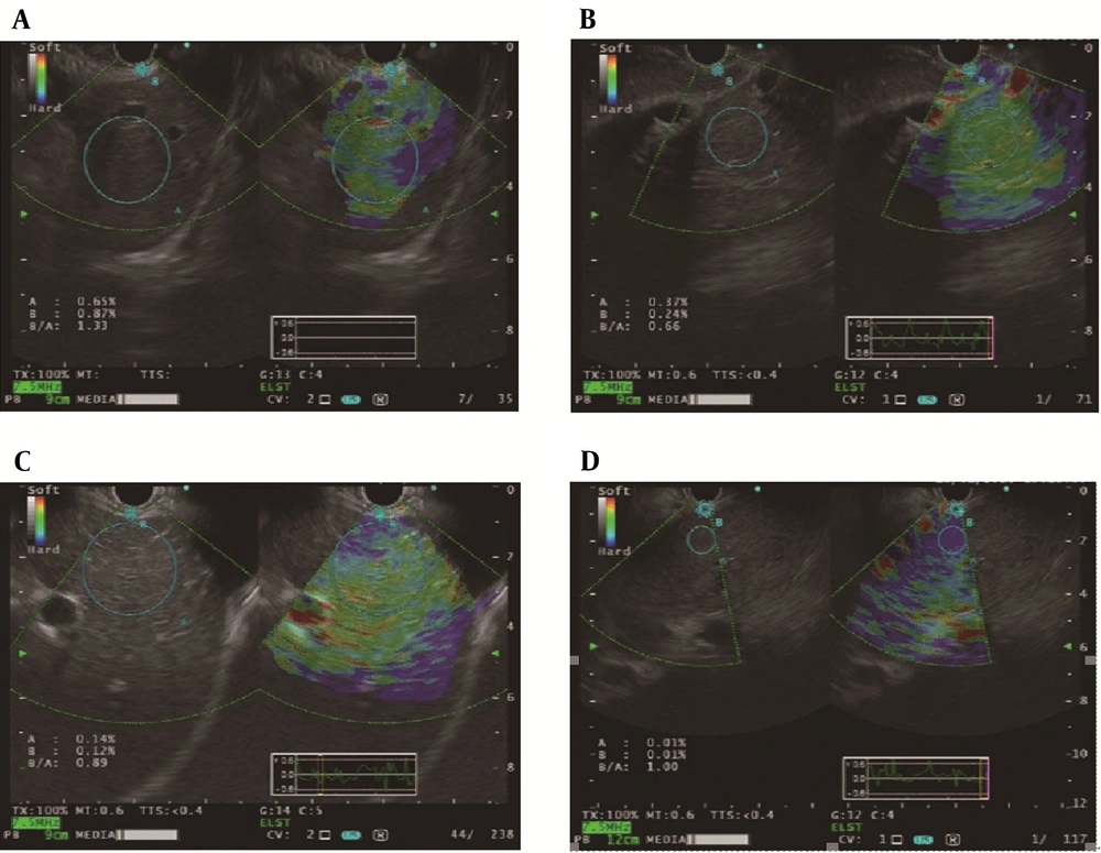 Strain ratio of liver fibrosis on pathological staging (S). A, S = 1, SR = 1.33; B, S = 2, SR = 0.66; C, S = 3, SR = 0.89; D, S = 4, SR = 1.00. Strain ratio of liver fibrosis on pathological staging (S). A, S = 1, SR = 1.33; B, S = 2, SR = 0.66; C, S = 3, SR = 0.89; D, S = 4, SR = 1.00.