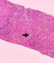 Severe Acute Hepatitis of Unknown Etiology in Pediatric Patients: Multidisciplinary Clinical Approach