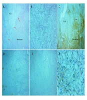 Immunohistochemical Subtypes of Hepatocellular Adenomas in Iranian Patients: A Cross Sectional Study in a Single Center