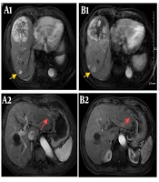 Unexpected Anti-tumor Effect of Selective Internal Radiation Therapy and Radiofrequency Ablation Followed by Immune Checkpoint Inhibitors for Hepatocellular Carcinoma
