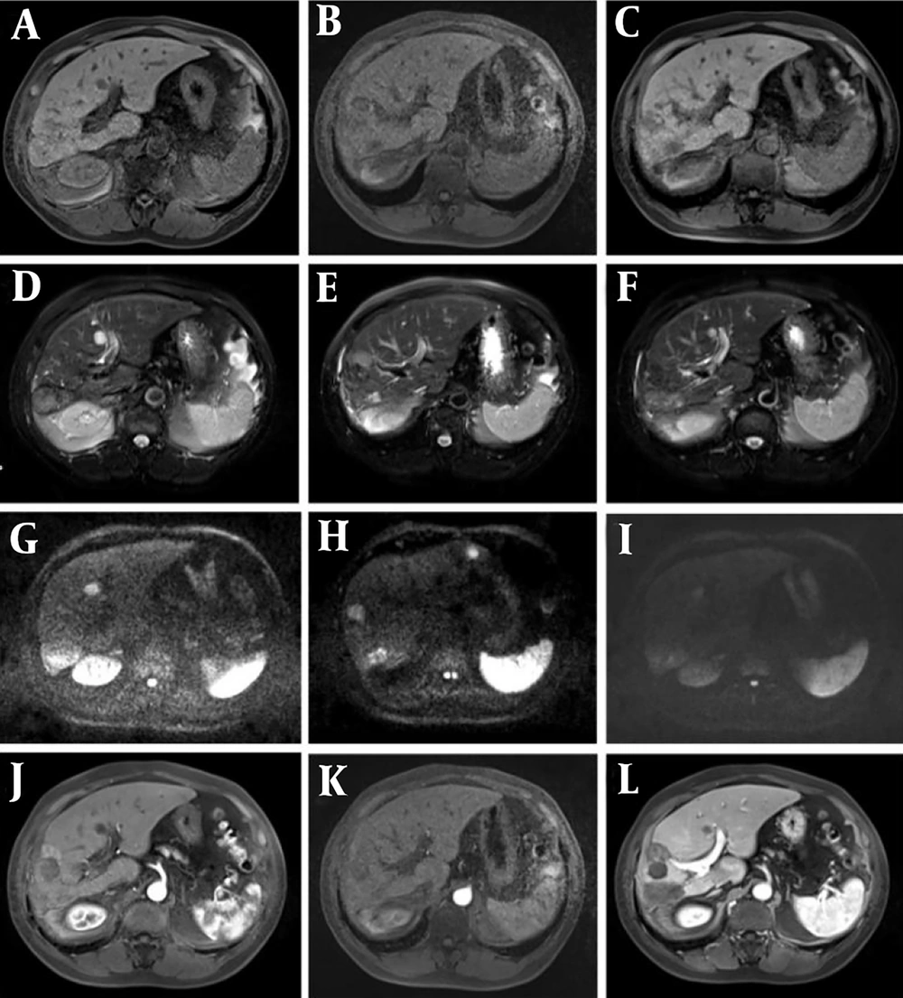 Representative magnetic resonance imaging (MRI) images of the HCC patient. Follow-up was conducted three months after transcatheter arterial chemoembolization (TACE) + radiofrequency ablation (RFA) surgery, and recurrence of the interventional lesion was found after 10 months of follow-up. A - C, T1-weighted imaging (T1WI) phase III (recurrence, suspicious, and postoperative groups); D - F, phase III T2-weighted imaging (T2WI) images; G - I, diffusion-weighted imaging (DWI) phase III images; J - L, LAVE enhanced arterial phase three phase images. When dynamic enhancement of liver acquisition with volume acceleration (LAVA) in the suspicious group showed marginal or nodular enhancement of the lesion, and small abnormal blood vessels were found, attention should be paid to the presence of viable tumor cells. Representative magnetic resonance imaging (MRI) images of the HCC patient. Follow-up was conducted three months after transcatheter arterial chemoembolization (TACE) + radiofrequency ablation (RFA) surgery, and recurrence of the interventional lesion was found after 10 months of follow-up. A - C, T1-weighted imaging (T1WI) phase III (recurrence, suspicious, and postoperative groups); D - F, phase III T2-weighted imaging (T2WI) images; G - I, diffusion-weighted imaging (DWI) phase III images; J - L, LAVE enhanced arterial phase three phase images. When dynamic enhancement of liver acquisition with volume acceleration (LAVA) in the suspicious group showed marginal or nodular enhancement of the lesion, and small abnormal blood vessels were found, attention should be paid to the presence of viable tumor cells.